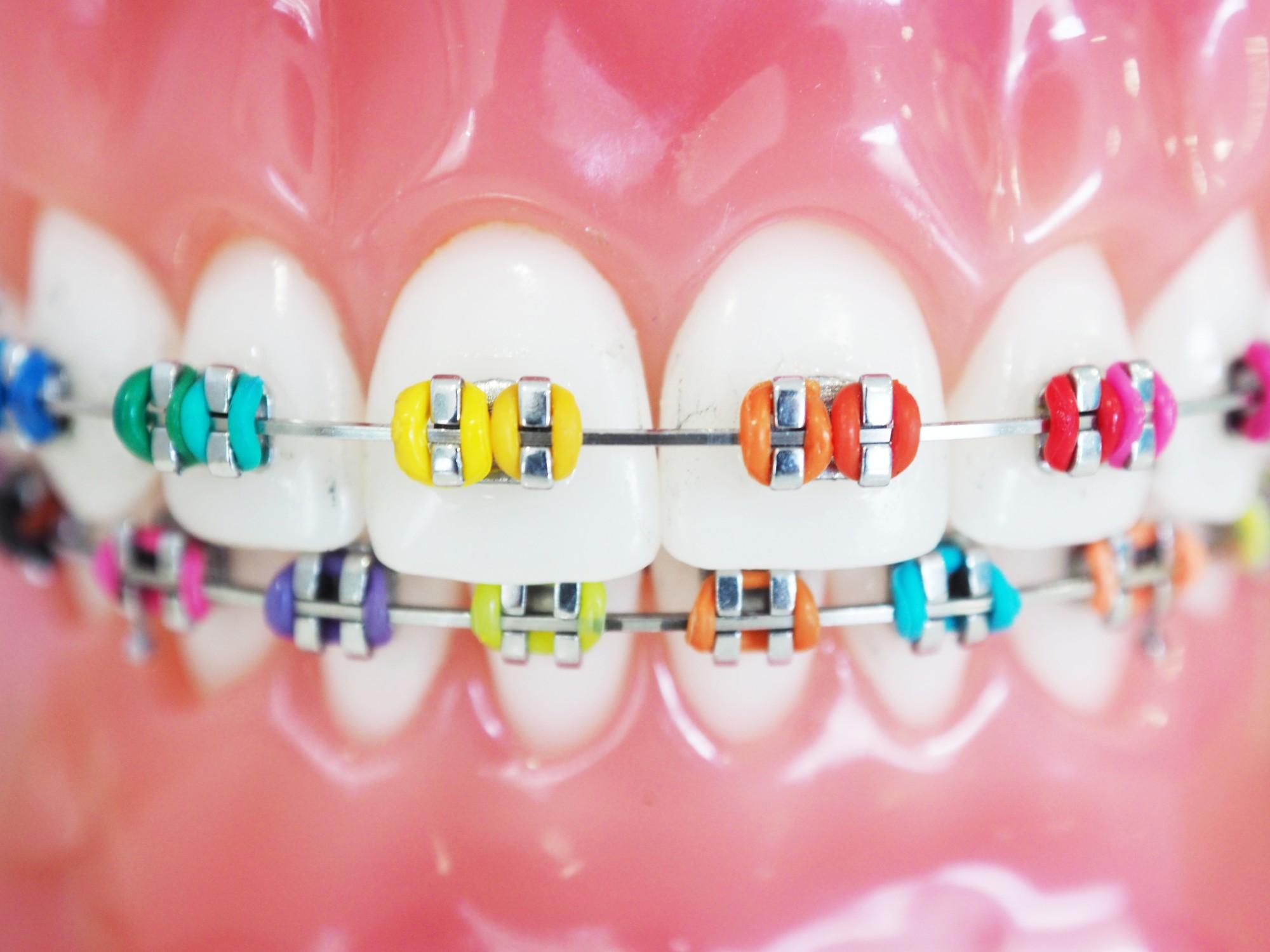 What Are The Tips To Choose The Right Braces Colors Ivanovortho