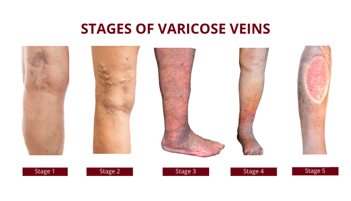 Vein Clinic: What To Expect During The Treatment From A Vein Removal ...