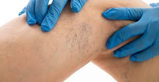 Varicose Vein Treatment Seattle, WA | Everett Varicose Vein Treatment