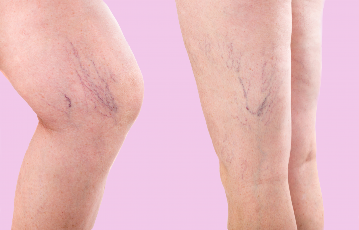 Varicose Veins What Are The Complications Vein Center Texas