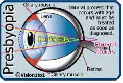 presbyopia correction