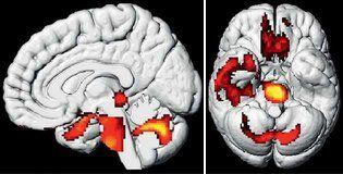 L\'activité en baisse de ces zones cérébrales (en rouge, vues au Pet scan) est liée aux perte d\'odorat, confusion, douleurs et insomnies du Covid long. Crédit : E. GUEDJ ET AL.