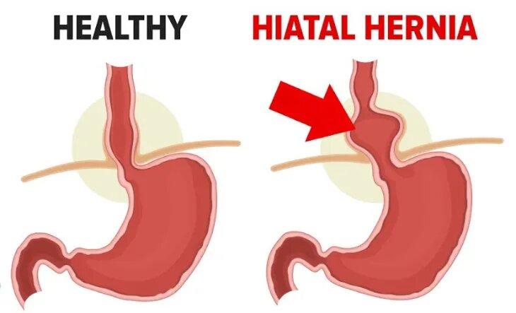 Hiatus Hernia Explained And A Possible Way Cure Justpasteit