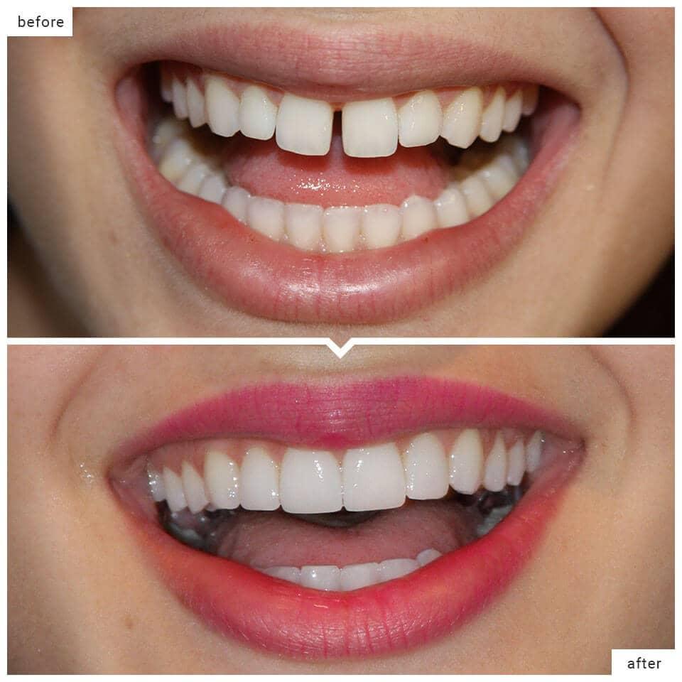 What Are The Different Types Of Dental Veneers Available Dental