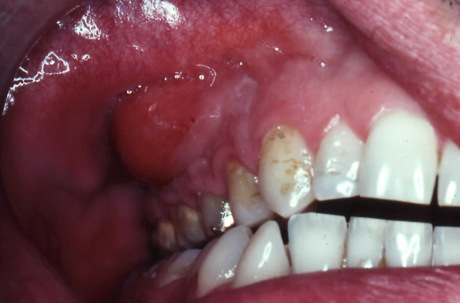 What Are The Stages Of Gum Abscess 