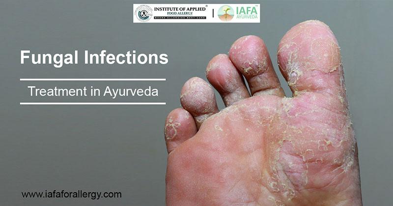 How To Treat Fungal Infections In Ayurveda Justpasteit
