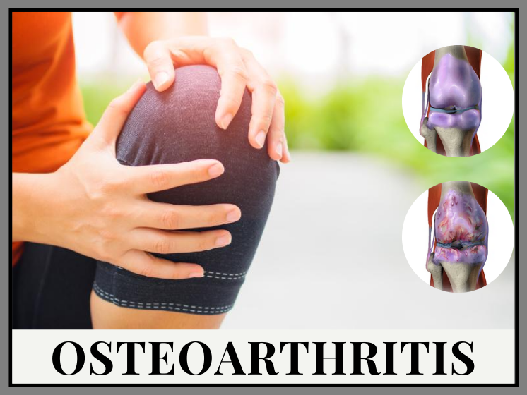 Osteoarthritis: Causes, Symptoms & Treatment - JustPaste.it