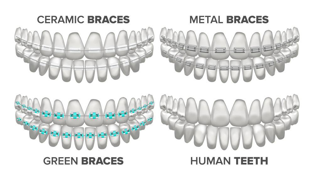 Teeth Alignment Braces, Aligners & Invisalign Comparison, Cost, The