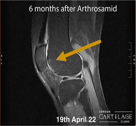 5 Knee Osteoarthritis Treatments You Should Know About! - JustPaste.it