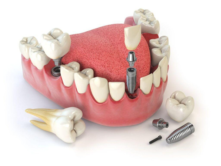 knowmoreaboutdentalimplants1024x768.jpg