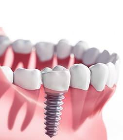 dentalimplants1.jpg