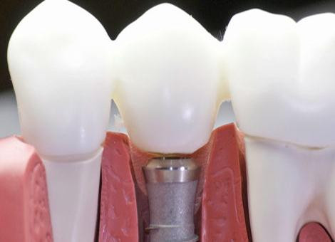 dental_implants2.jpg