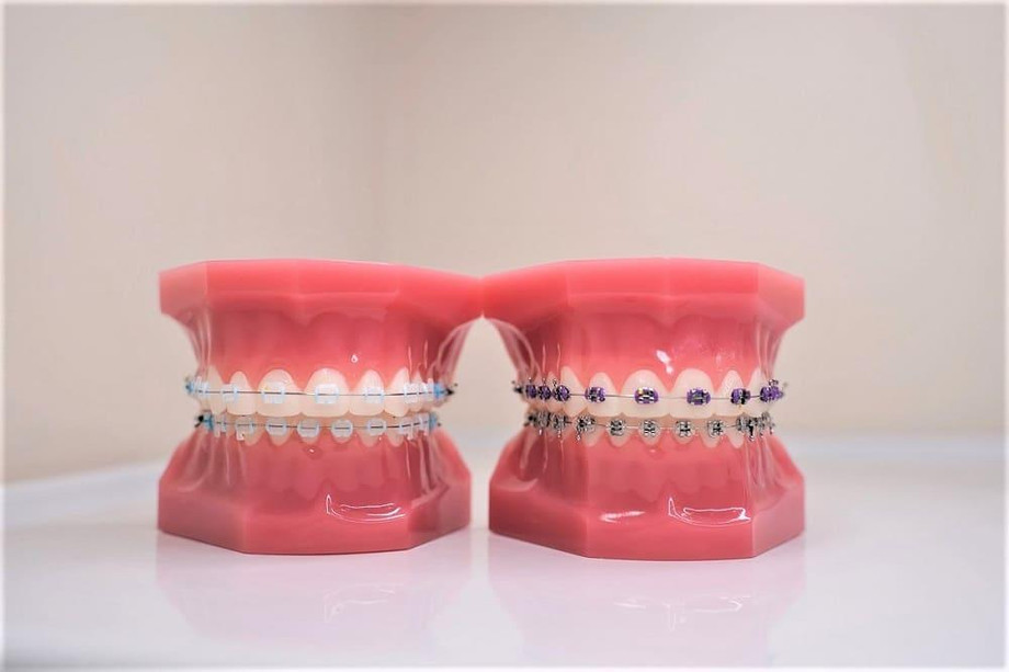 clearceramicporcelainbracesvsmetalbraces.jpg