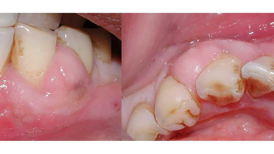 4572gum_abscess1296x728body.jpg