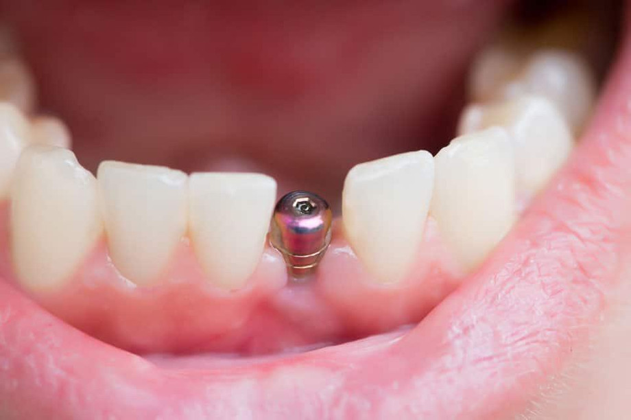 knockedouttoothdentalimplant.jpg