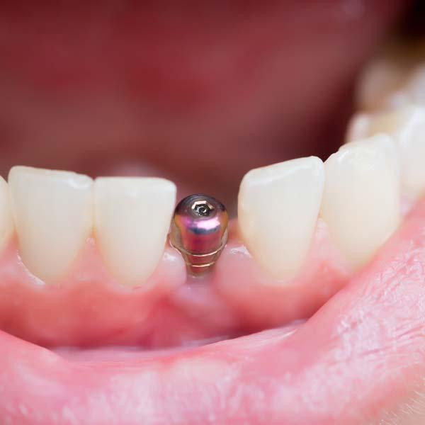 singletoothimplantnearme.jpg