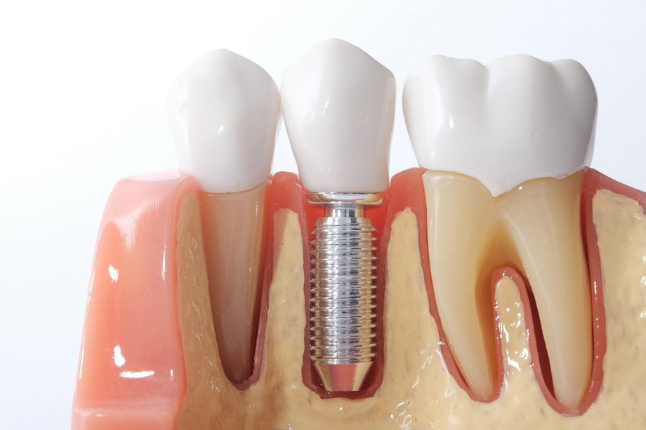 dentalimplantcosts.jpg
