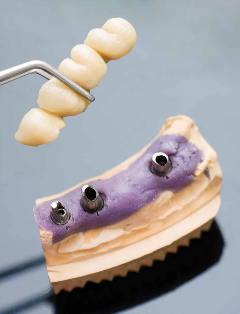 dentalimplantcost.png