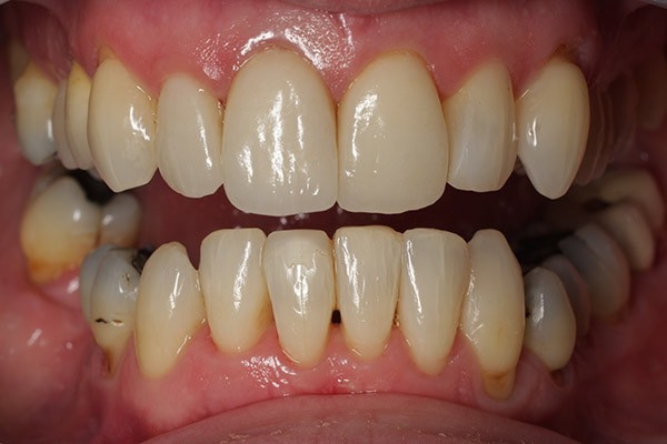 invisalign26compress.jpg