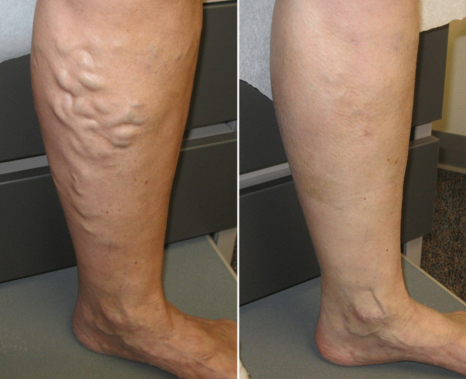 Spider Vein Treatment Which One To Choose Sclerotherapy Or Compression