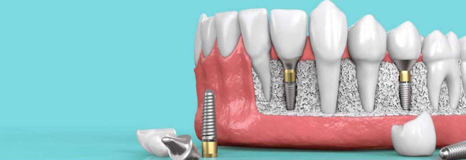 dentalimplants11536x528.jpg