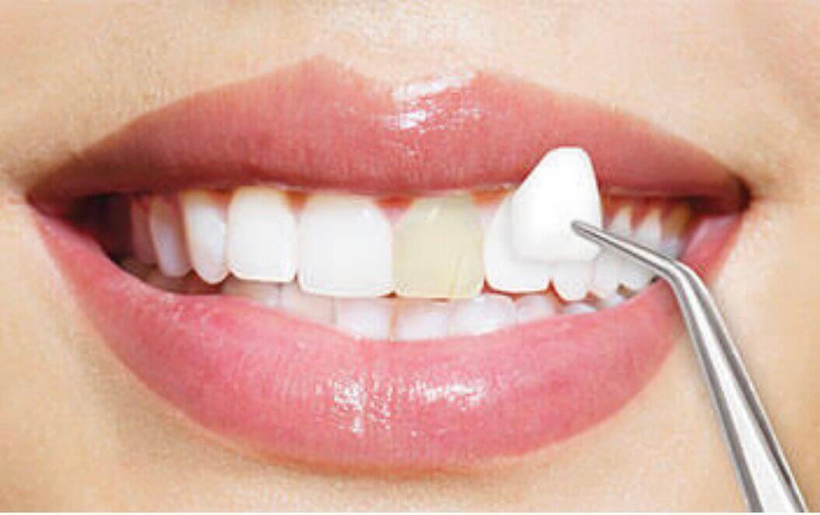 dentalveneers.jpg