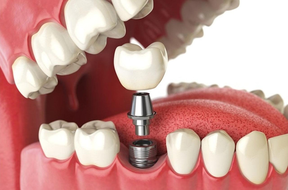 dentalimplants.jpg