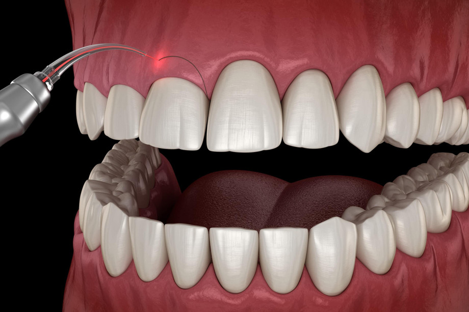 gingivectomyscaled.jpg