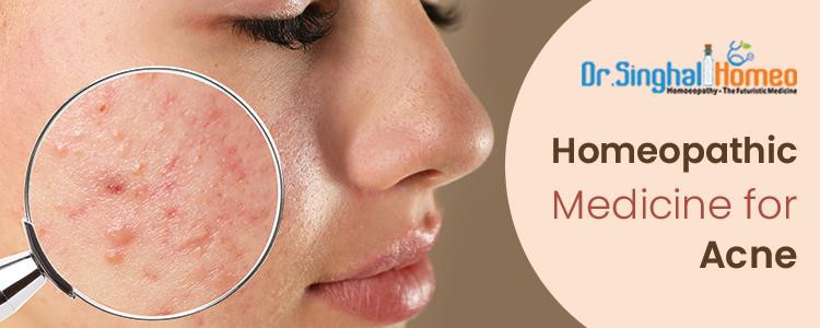 Get Effective Homeopathic Medicine for Pimples & Acne Scars