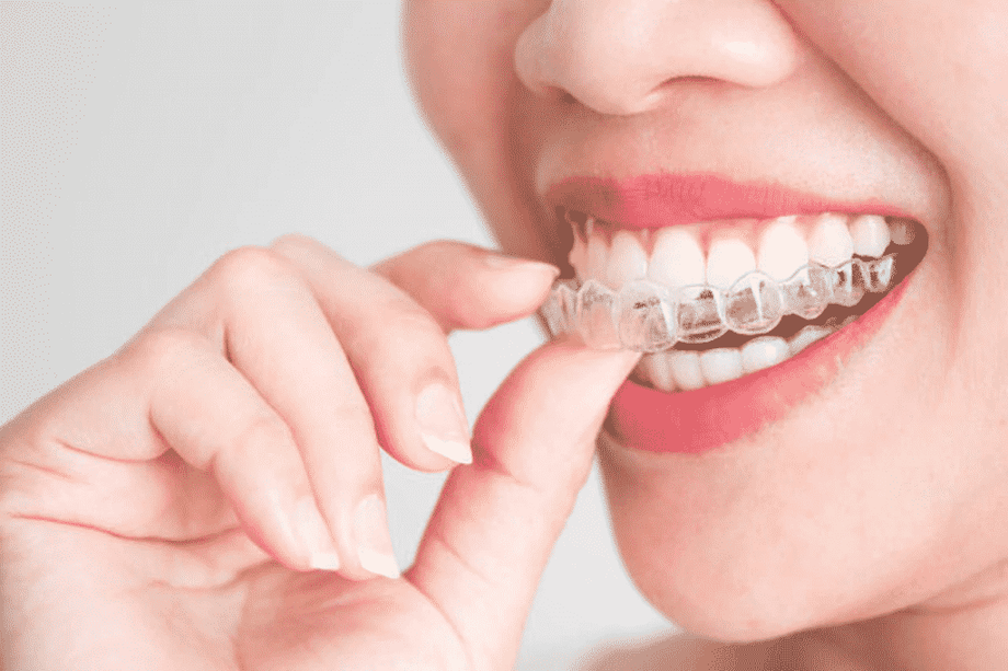 invisalignclearaligners1024x682.png