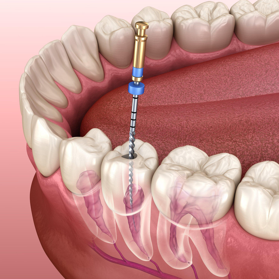 ccdentalrootcanaldiagram.jpg