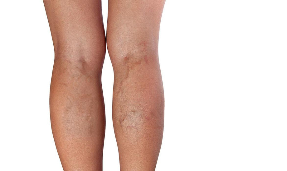 varicoseveins1170x700.jpg