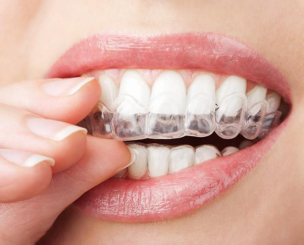 invisalign1.jpg