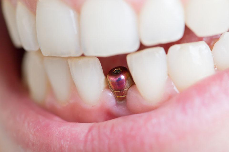 dentalimplant.jpg