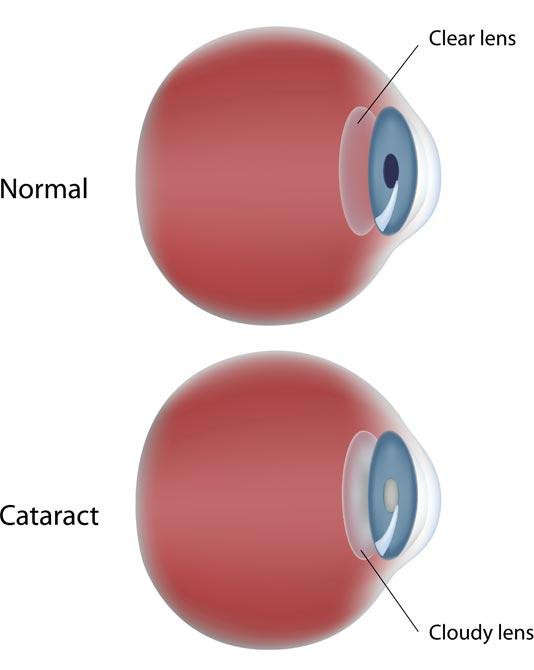 cataract.jpg