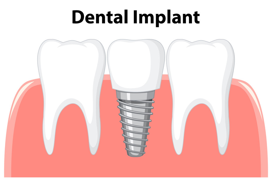 Dental Implants in Gurgaon