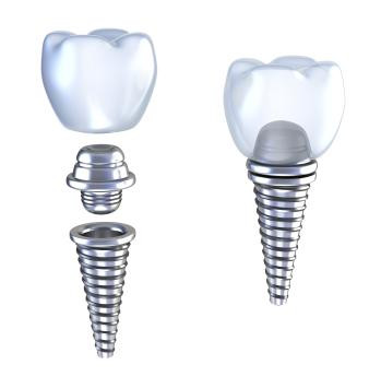 dentalimplantdiagrambeingattachedtogether.jpg