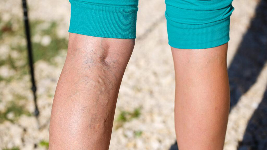 varicoseveins5.jpg