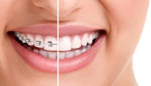 braces300x172.jpg