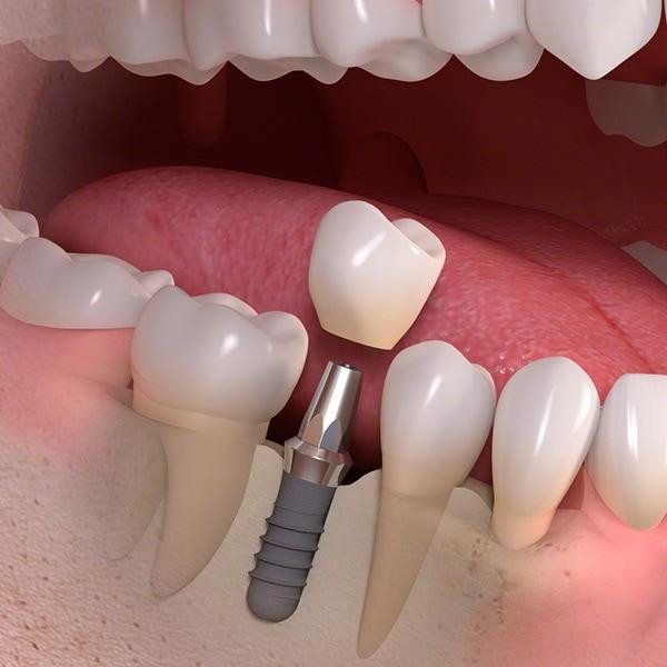 singletoothdentalimplantabutmentcrown.jpg