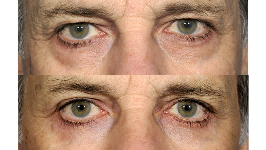 before_and_after_eye_bag_surgery1296x728gallery_slide1.jpg