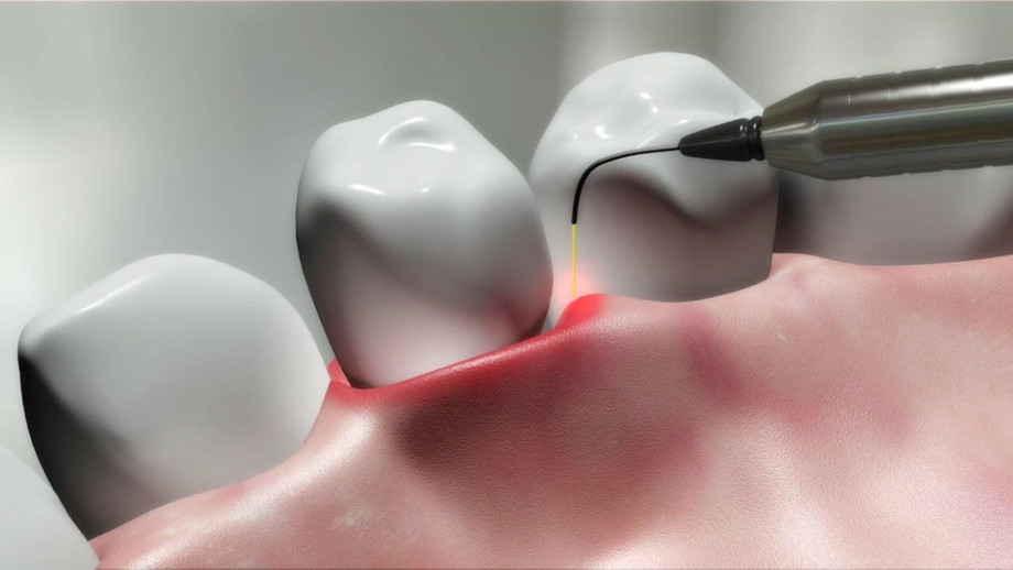 laserindentistry_1.jpg