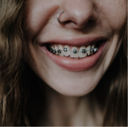 What are dental braces? How many types of braces are there? - Best