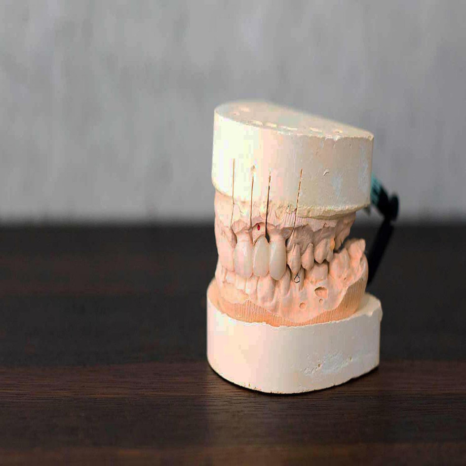 porcelainbridgehoustondental1.jpg