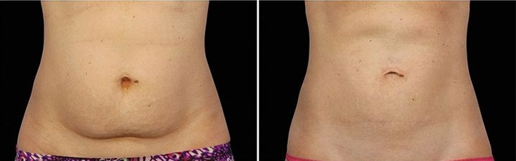 beforeand16weeksafterphotosforcoolsculpting.jpg