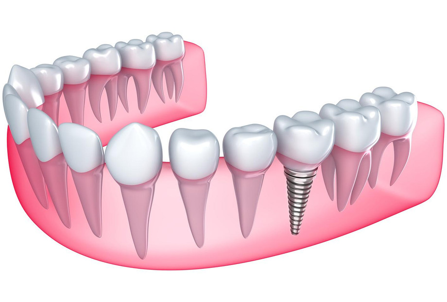 dentalimplants.jpg