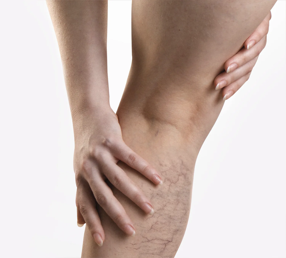vipcenters_spiderveins_treatment_img1webp.png