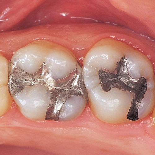 dentalfillings500x500.jpg