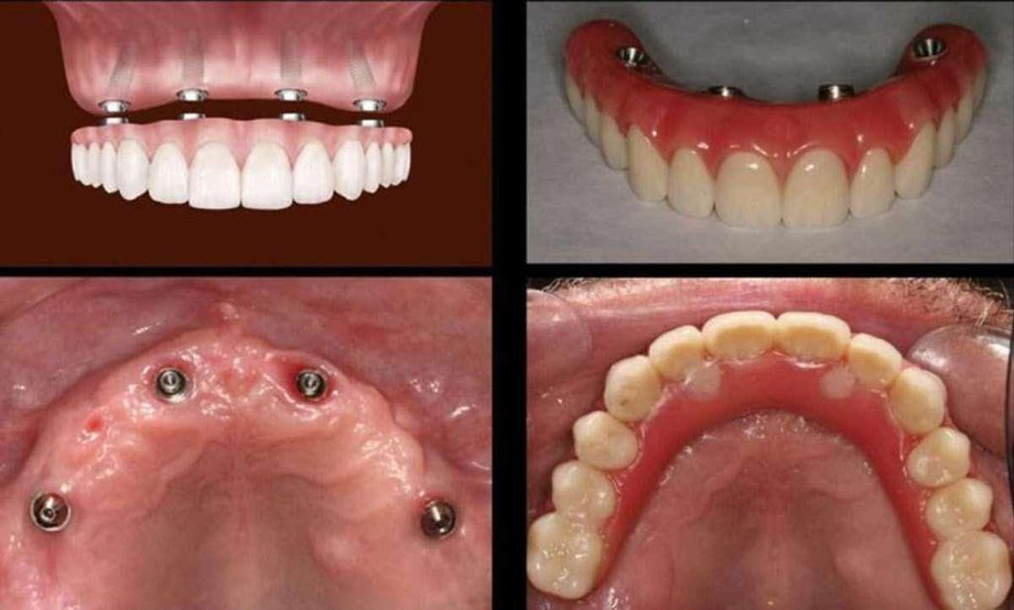 dentalimplantsnearme.jpg