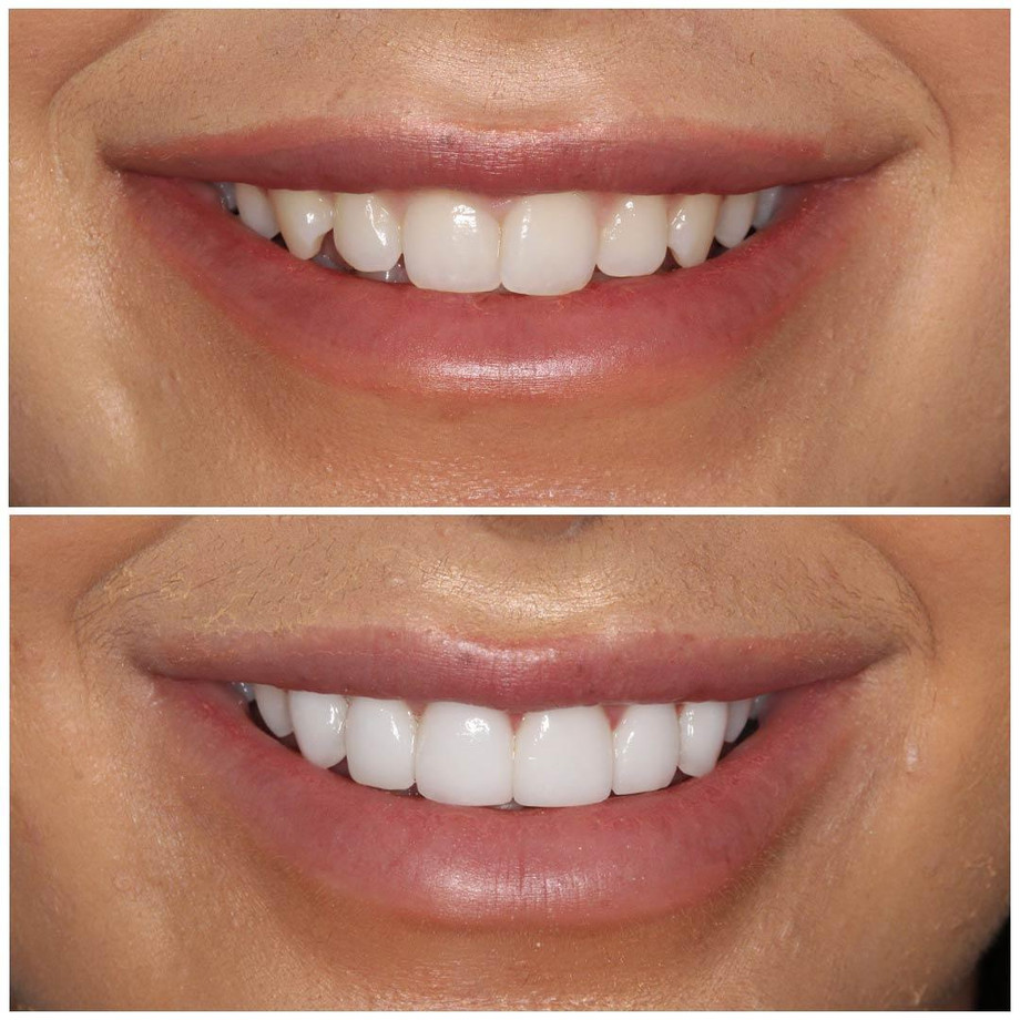 smilingdentalporcelainveneersbeforeafter15.jpg